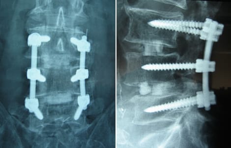 Should You Get Back Surgery? 9 Should You Get Back Surgery?