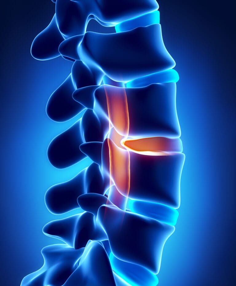 Avoid, Prevent and Treat Disc Herniation 6 Avoid, Prevent and Treat Disc Herniation