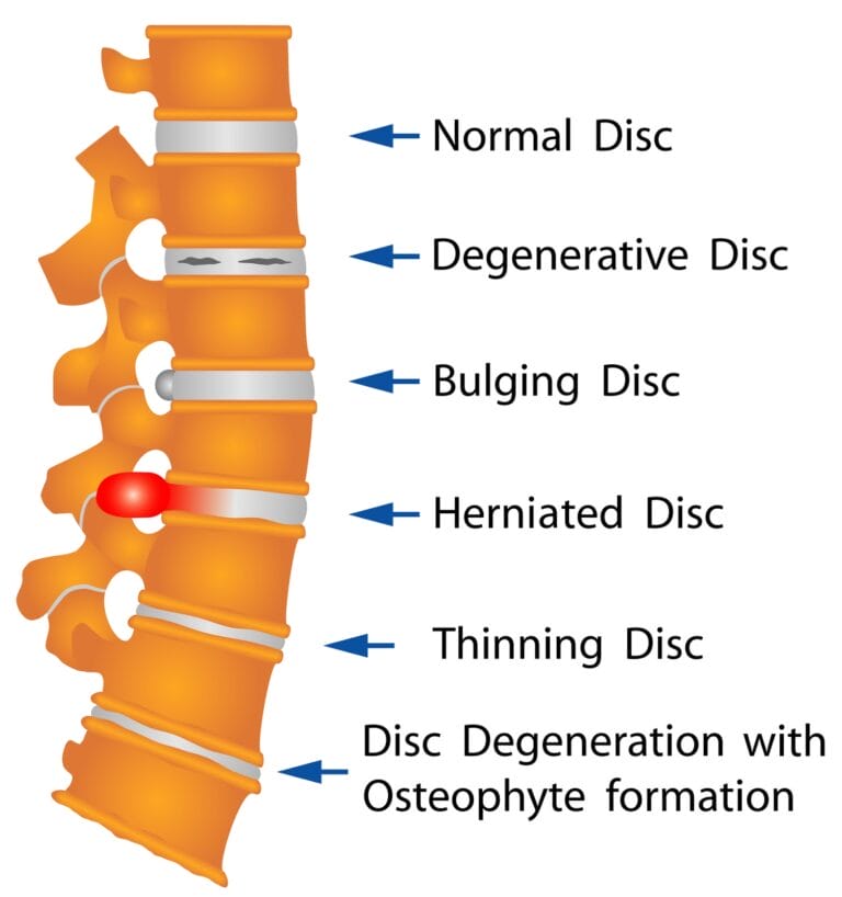 The Easiest Way to Prevent Disc Degeneration 6 The Easiest Way to Prevent Disc Degeneration