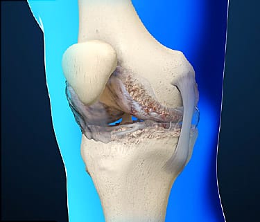 Treat Osteoarthritis Without Pain Meds 7 Treat Osteoarthritis Without Pain Meds