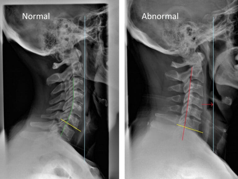 Neck and Shoulder Tension: Heavy Head? 4 Neck and Shoulder Tension: Heavy Head?