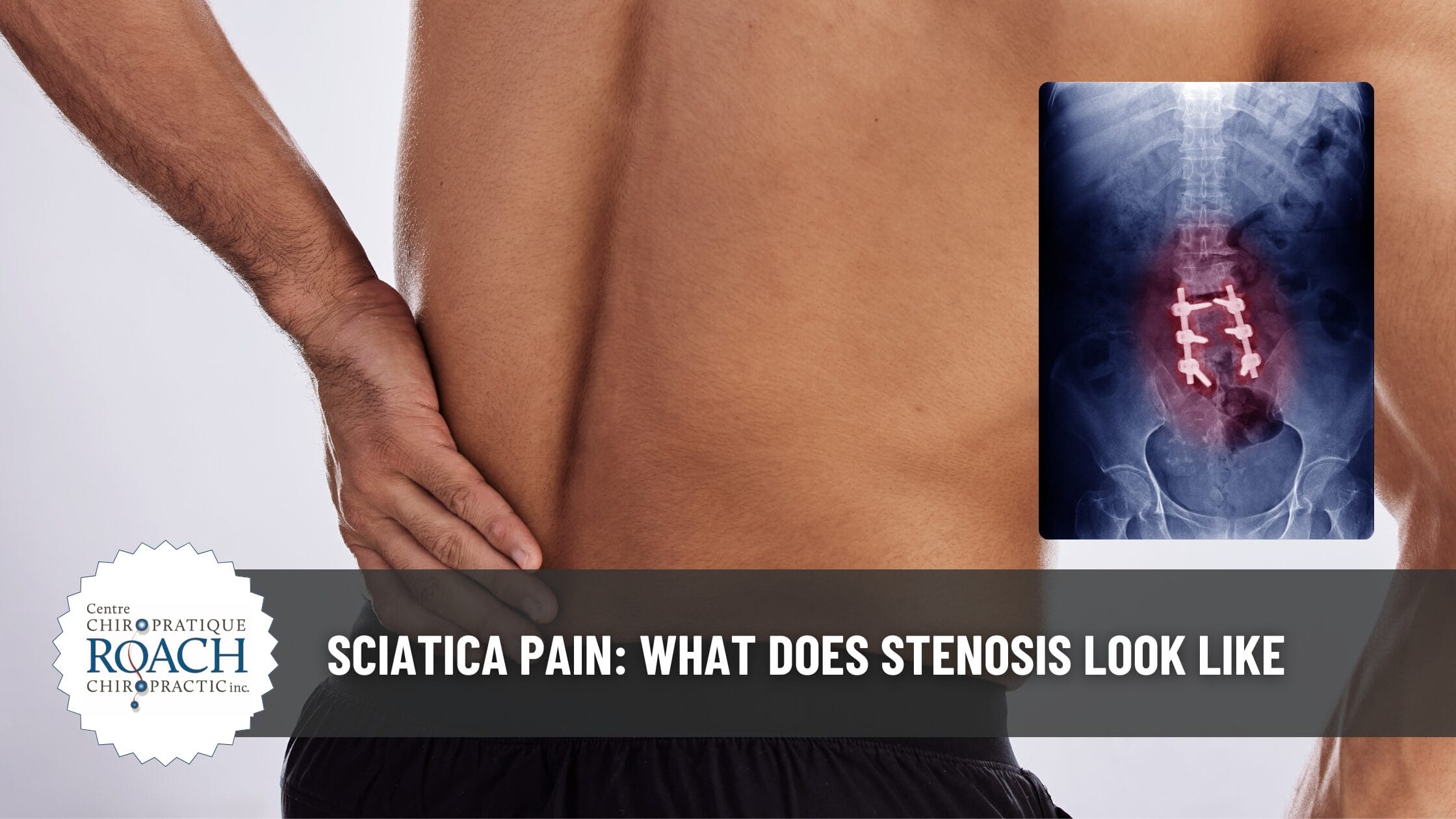 a person holding their lower back along with an example x-ray of sciatica, stenosis.